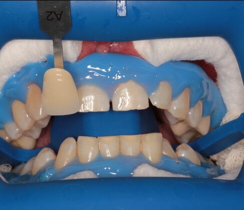 Шаширина отбеливание 2 - До