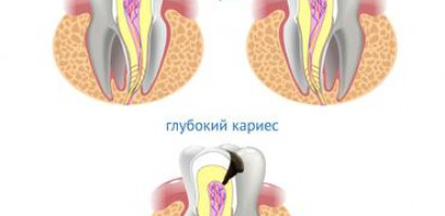 Шкала Блэка