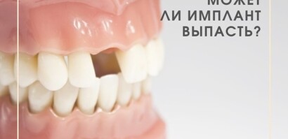 Выпадение имплантов