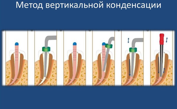 Вертикальная конденсация гуттаперчи